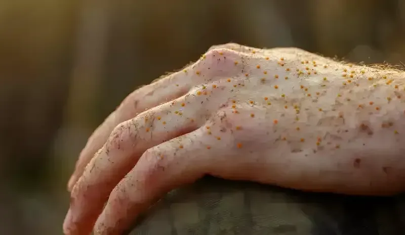 Bacterial Skin Infection Treatment & Prevention