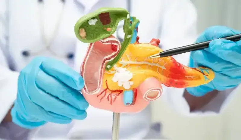 Gallbladder Without Surgery - Gallstone Removal Options