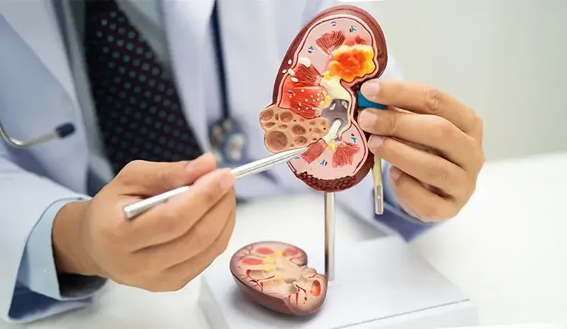 Chronic Kidney Disease Progression and Stages