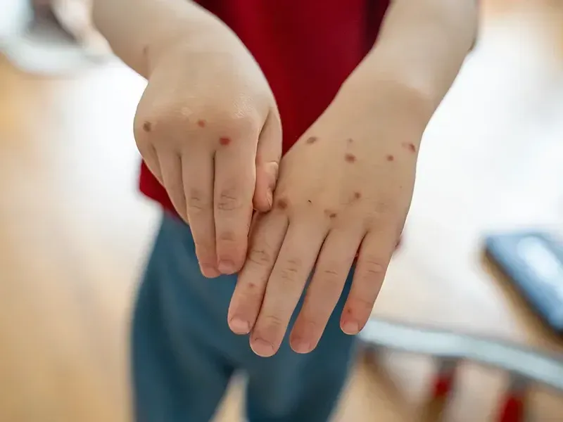 Malaria - Treatment and Recovery Explained