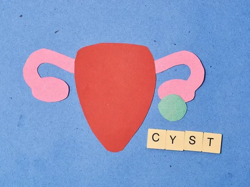 Ovarian Cyst - A Complete Monitoring Guide