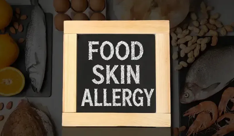 Food Skin Allergy