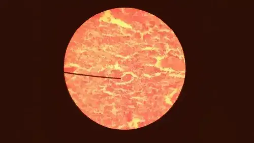 Health insurance for Thymus Cancer