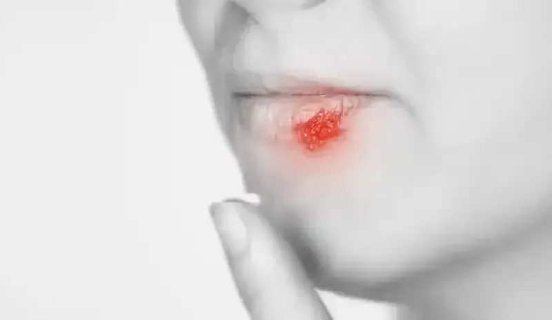 Effective Mouth Ulcer Treatment and Care