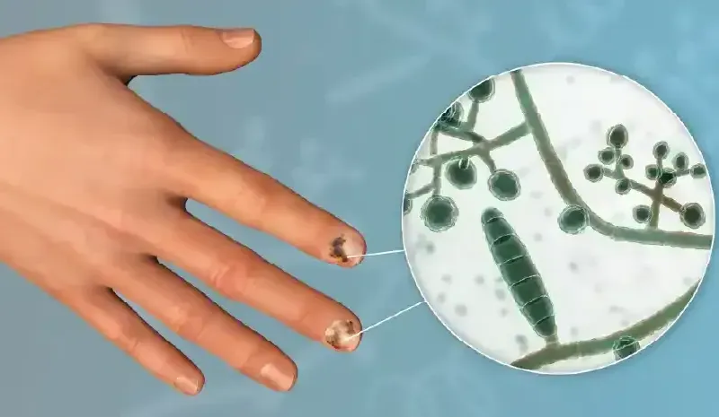 Nail Infections: Medical and Home-Based Treatment Options