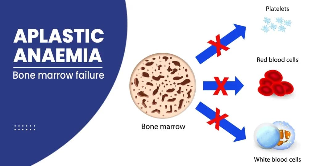 Aplastic Anaemia - Symptoms, Causes, Diagnosis, and Risk factors