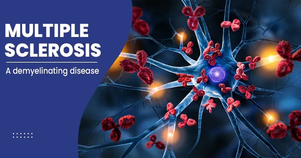 Multiple sclerosis – Symptoms, Causes, Diagnosis, and Treatments