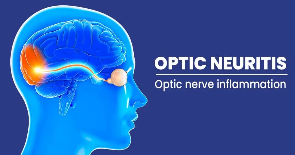 Optic Neuritis Symptoms, Causes, Diagnosis, and Preventions 