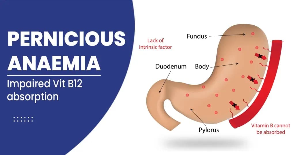 Pernicious Anaemia  Symptoms, Causes, Diagnosis, and Treatments    