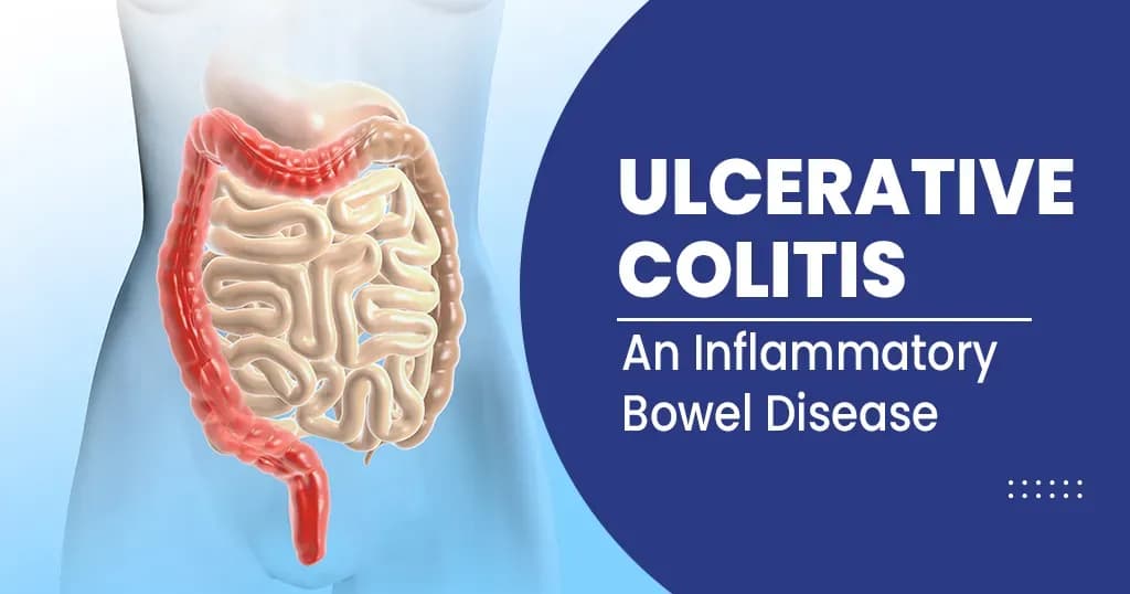 Ulcerative Colitis  Symptoms, Types, and its Complications