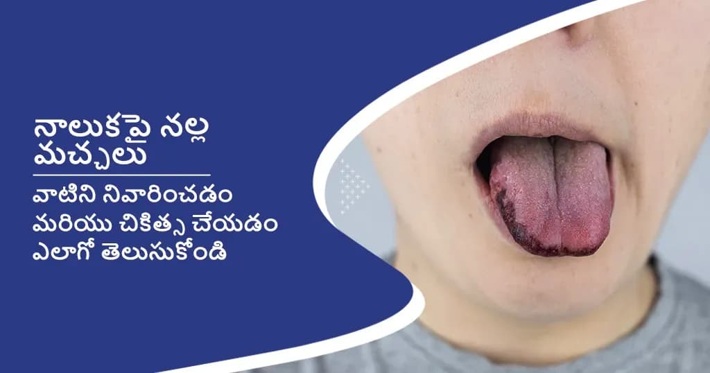 నాలుకపై నల్ల మచ్చలు-లక్షణాలు, కారణాలు మరియు చికిత్స