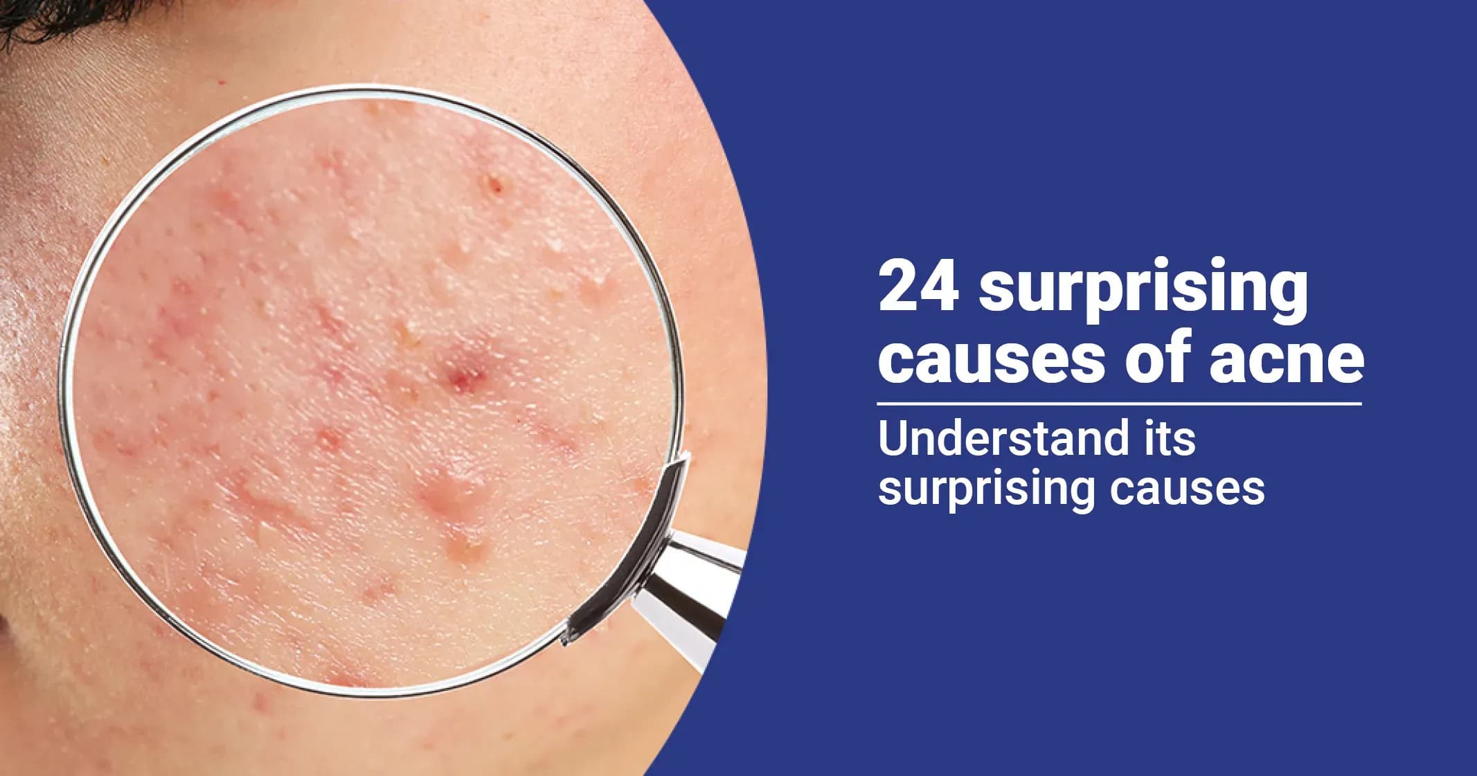 24 Surprising Causes of Acne Breakouts  