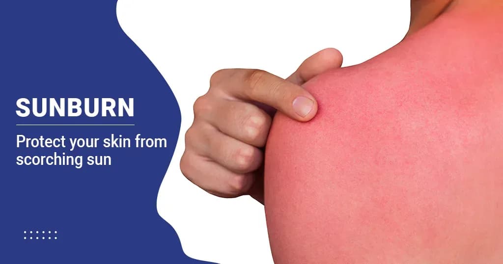 Sunburn Causes, Symptoms and Treatment  