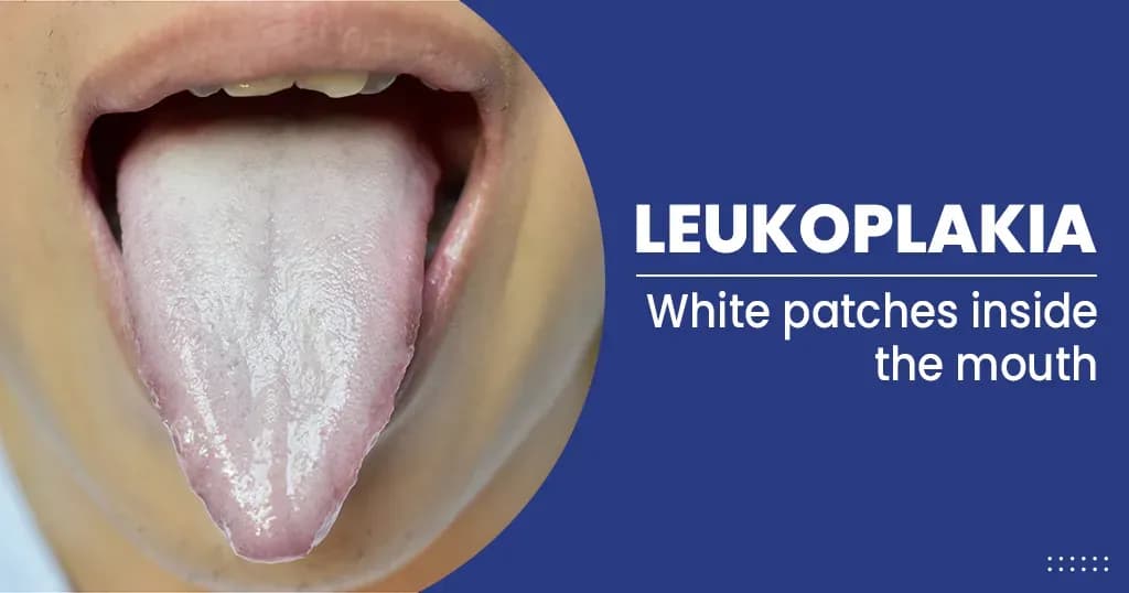 Leukoplakia Causes, Symptoms, Diagnosis and Treatments 
