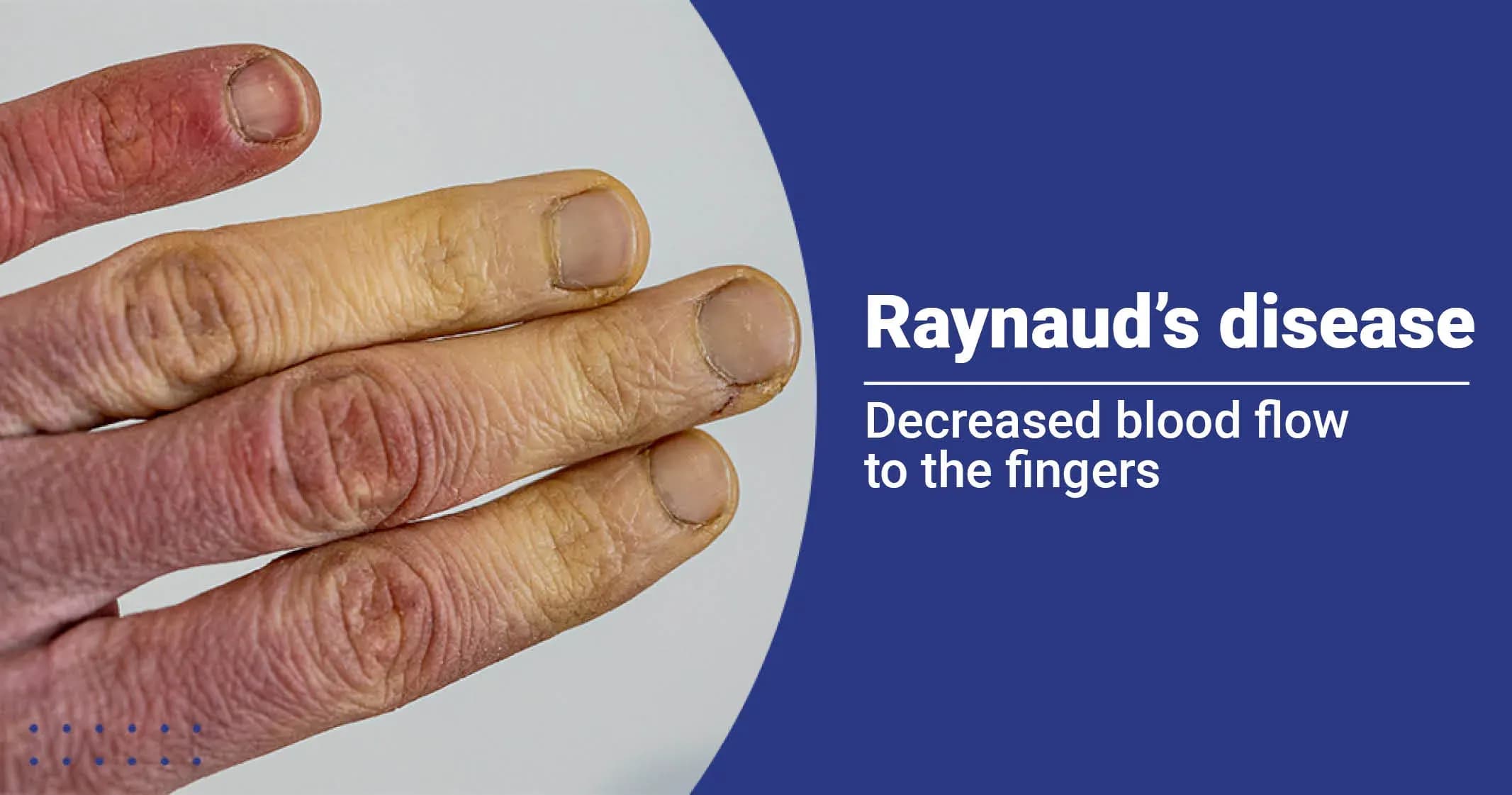 Raynaud's disease - Causes, Symptoms, Treatments & More 
