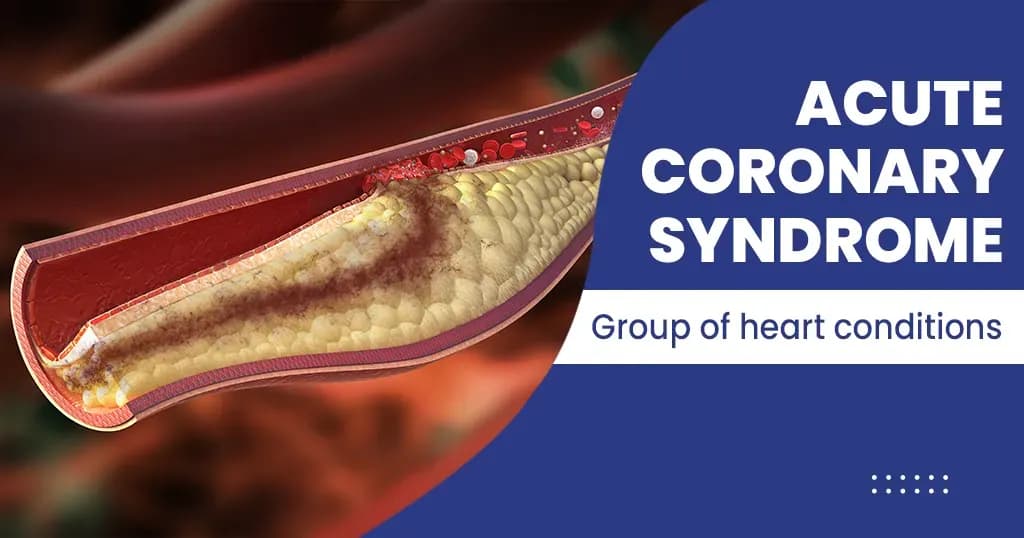 Acute Coronary Syndrome Symptoms, Causes, Treatments, and More 