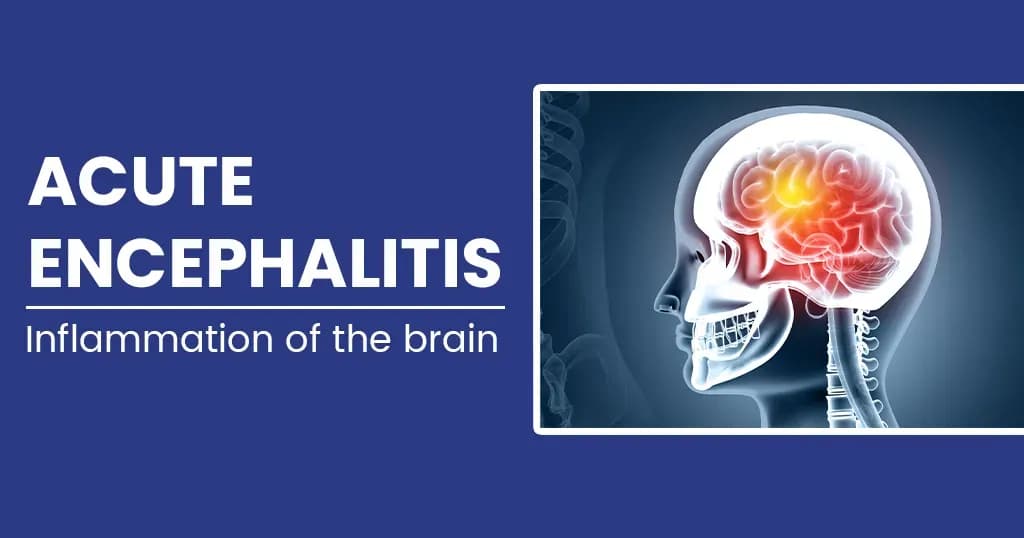 Acute Encephalitis Causes, Symptoms, Diagnosis and Treatments 