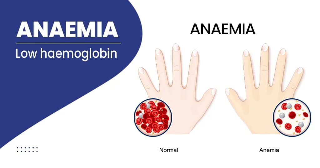 Anaemia Types, Symptoms, Causes and Treatments 