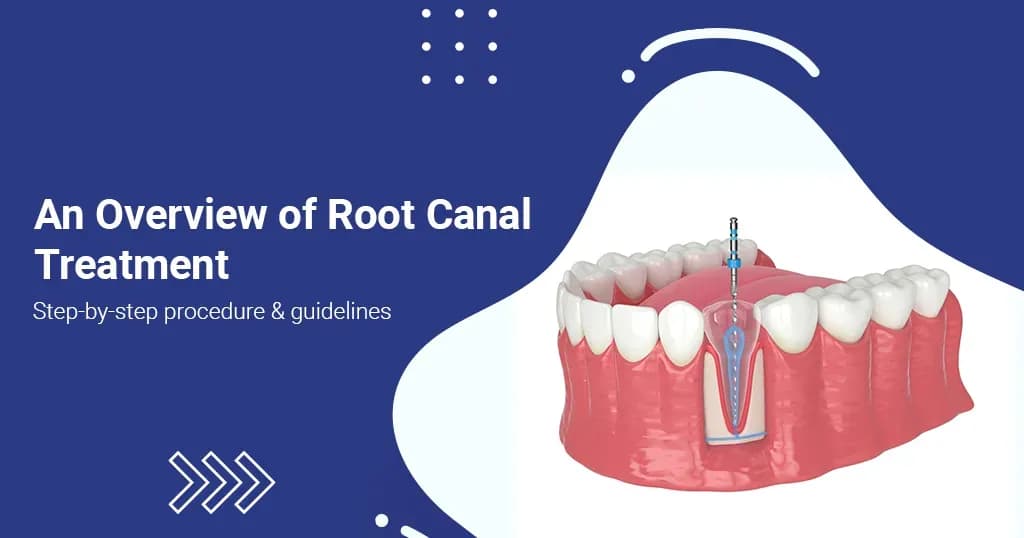 Root Canal Treatment: Step By Step Procedure & Guidelines