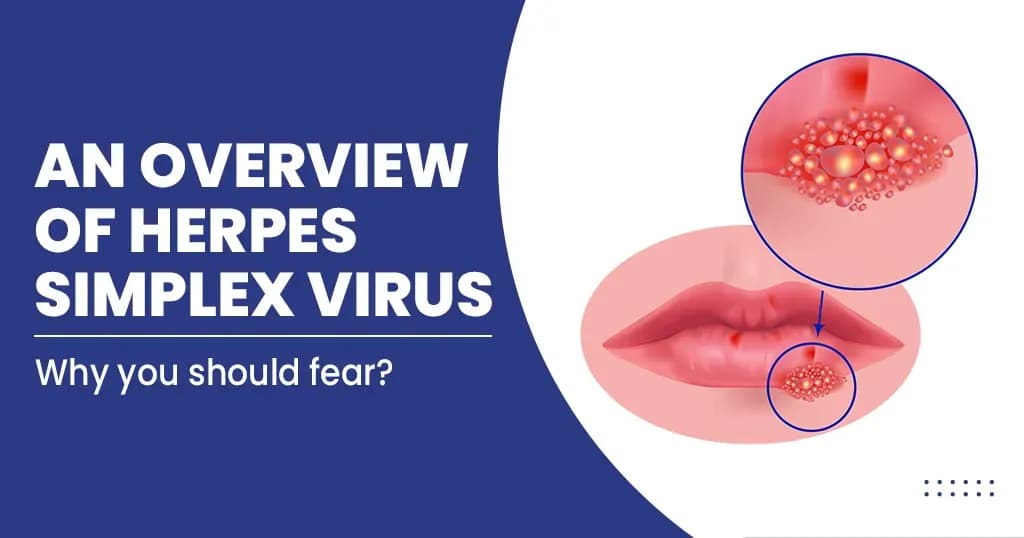 An Overview of Herpes Simplex Virus