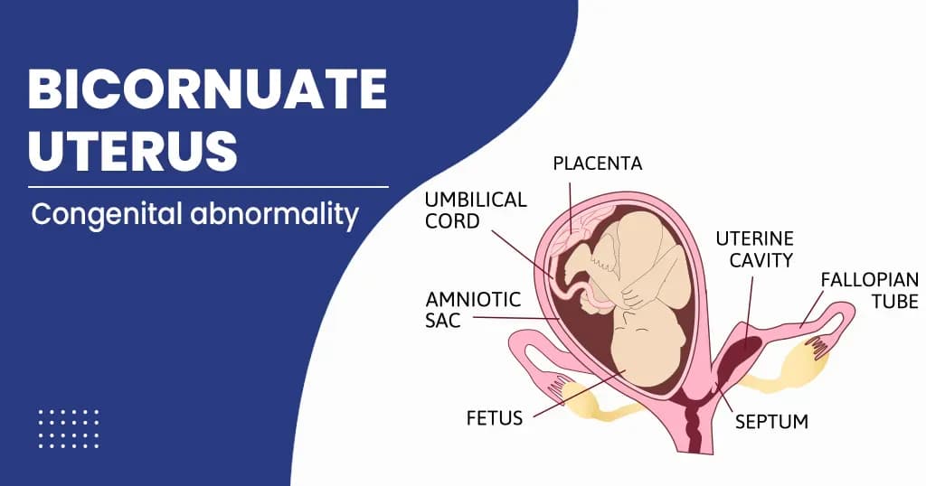Bicornuate Uterus Treatment and All About It 