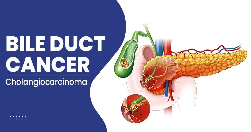 Bile Duct Cancer Types, Symptoms, Causes, Risk Factors, and More