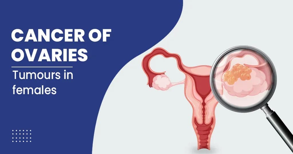 Ovarian Cancer  Symptoms , Diagnosis, Treatments, and More