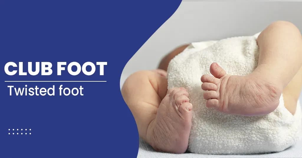 Club Foot Types, Risk Factors, Symptoms, and Treatments