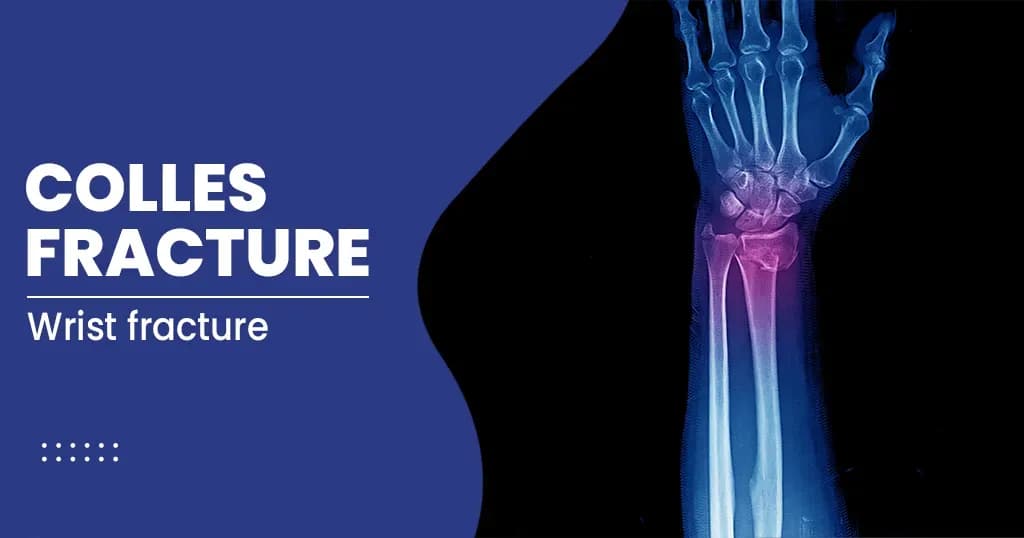 Colles Fracture Types, Symptoms, and Treatments