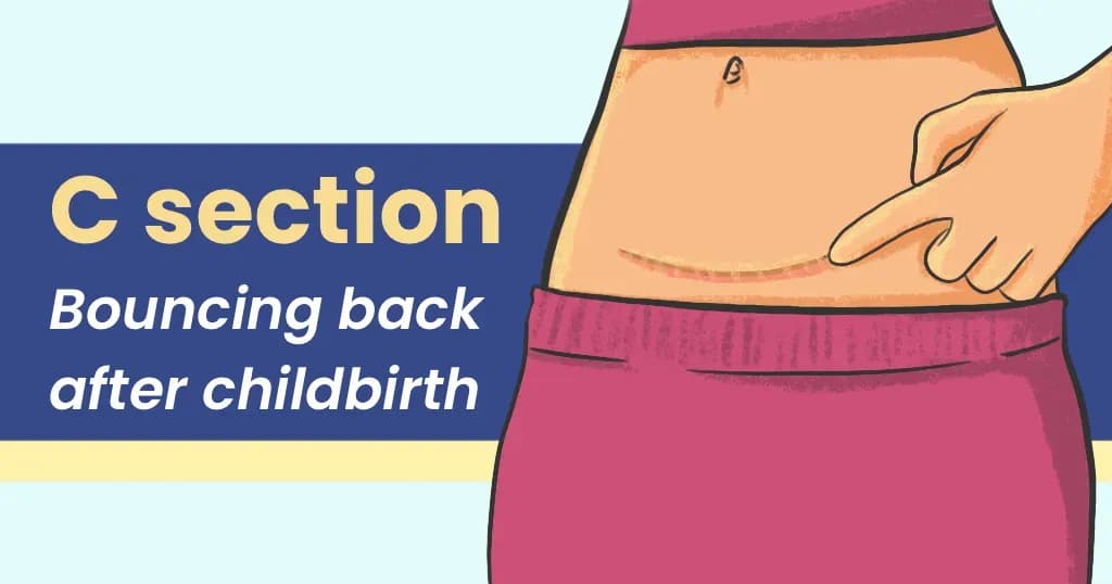 Caesarean Section and 6 Ways to Recover Faster