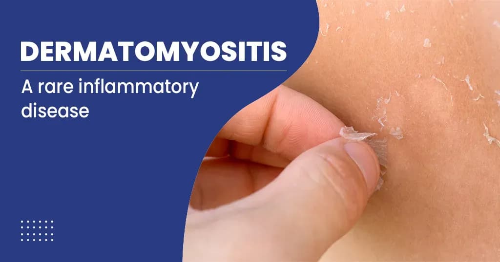 Dermatomyositis  Causes, Diagnosis and Treatment