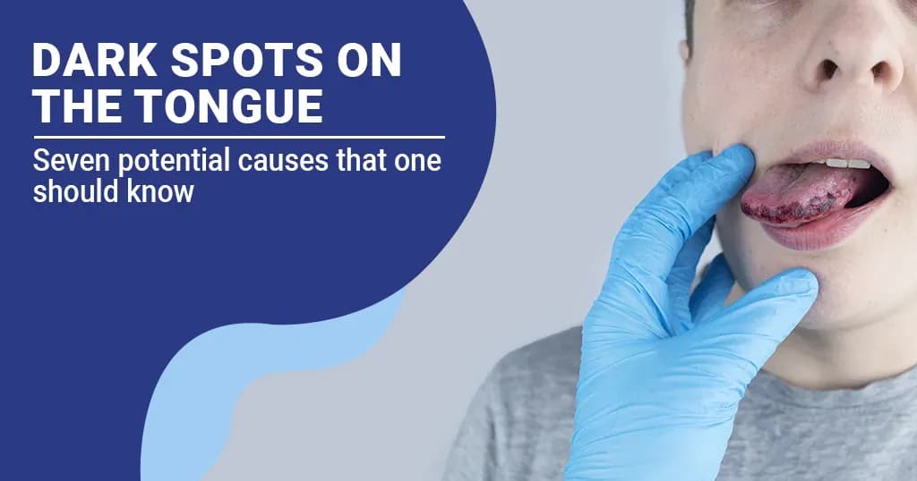 Dark Spots on the tongue - Their Causes & Treatments 