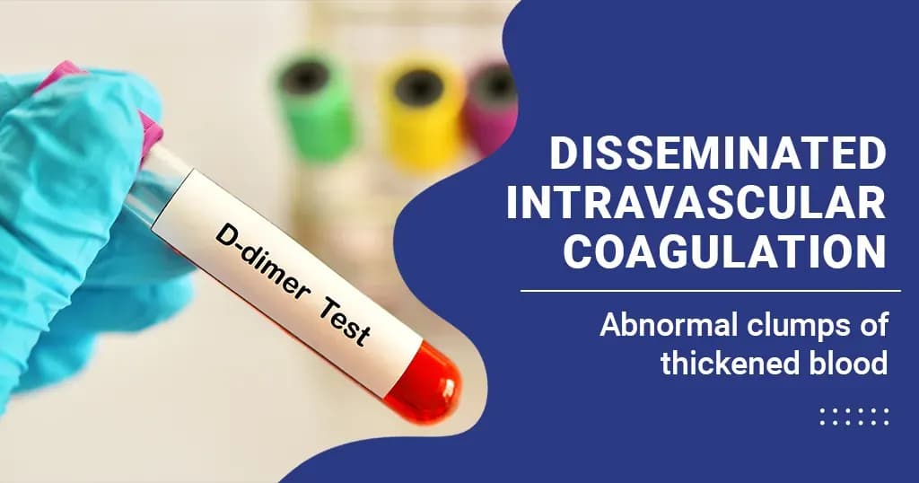 Disseminated Intravascular Coagulation Causes, Symptoms, Treatment and More