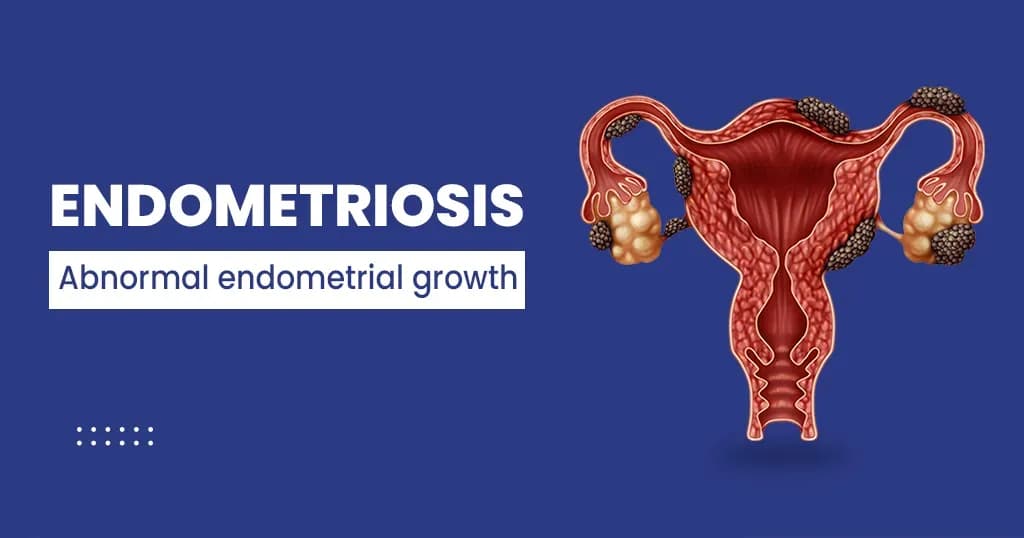 Endometriosis Symptoms, Causes, Stages & Treatment Options  
