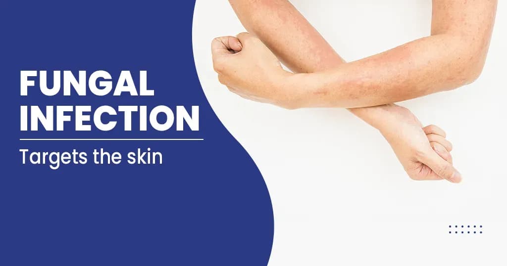 Fungal Infection  Symptoms, Causes and Treatment 

