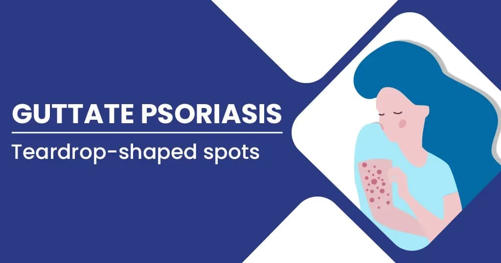 Guttate Psoriasis Causes, Stages, Diagnosis, and Treatments