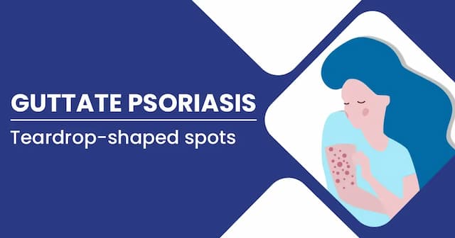 Guttate Psoriasis Causes, Stages, Diagnosis, and Treatments