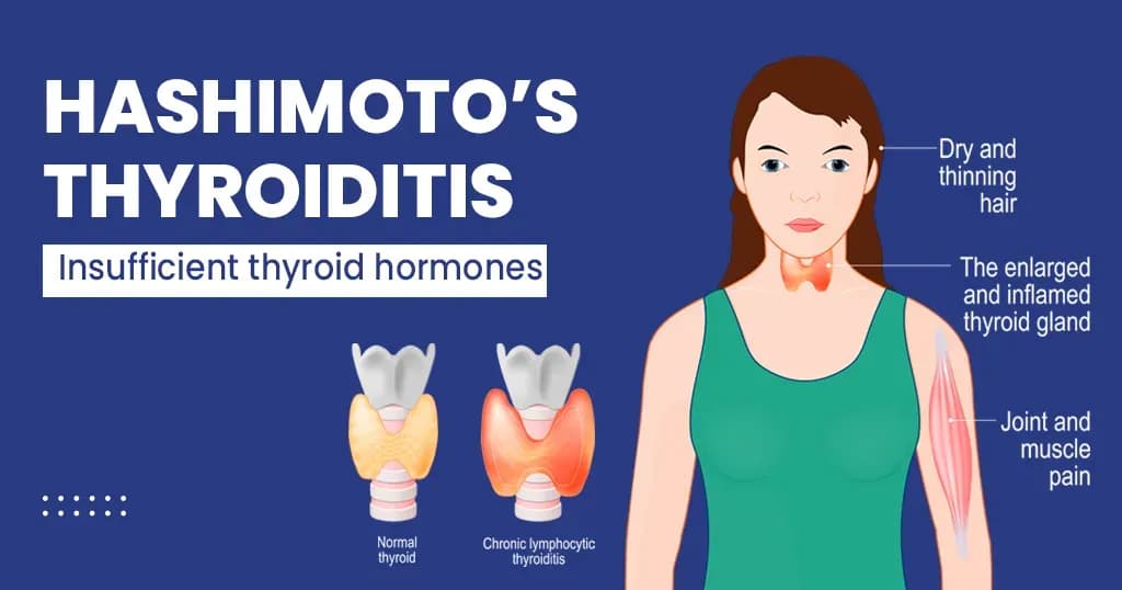 Hashimoto's Thyroiditis Causes, Symptoms, Diagnosis and Treatment 