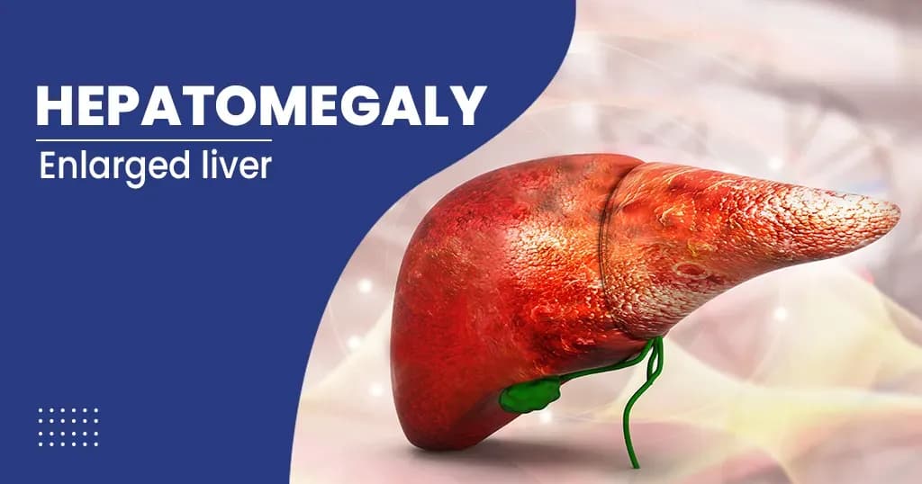 Hepatomegaly