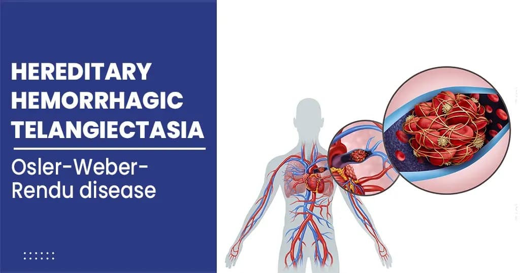 Hereditary Hemorrhagic Telangiectasia Symptoms and Treatments 
