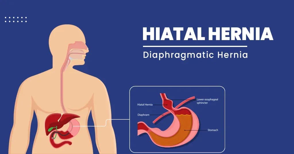 Hiatal Hernia Symptoms, Causes, and Treatment
