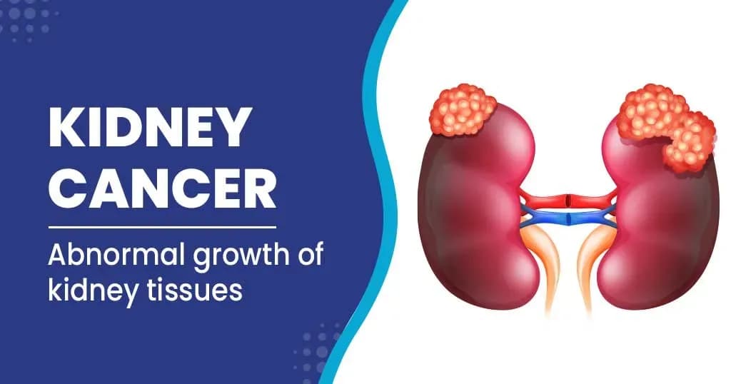 Kidney Cancer Causes, Risk factors and Treatments