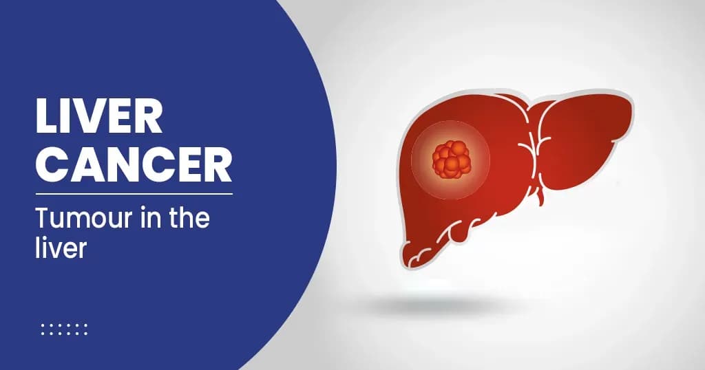 Liver Cancer Causes, Symptoms, Risk factors and Prevention