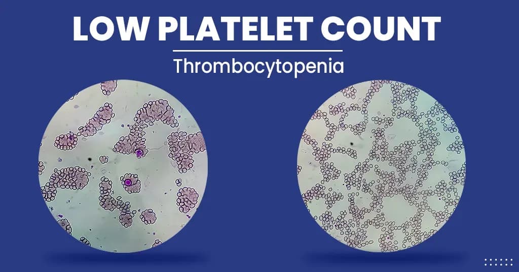 Low Platelet Count  Symptoms, Diagnosis, Treatment, and More  