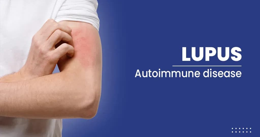Lupus Types, Causes, and Risk Factors