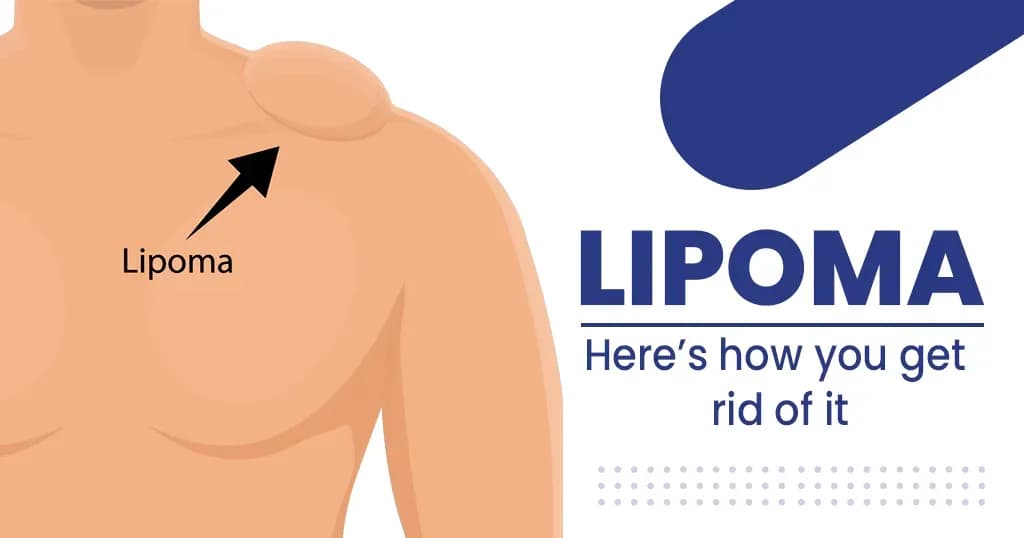 Lipoma Causes, Symptoms and Its  Removal 