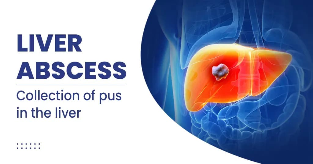 Liver Abscess Causes, Symptoms, Diagnosis and Treatment 