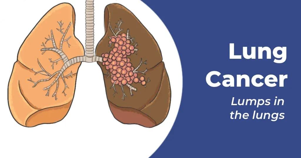 Lung Cancer : Symptoms, Signs and Stages
