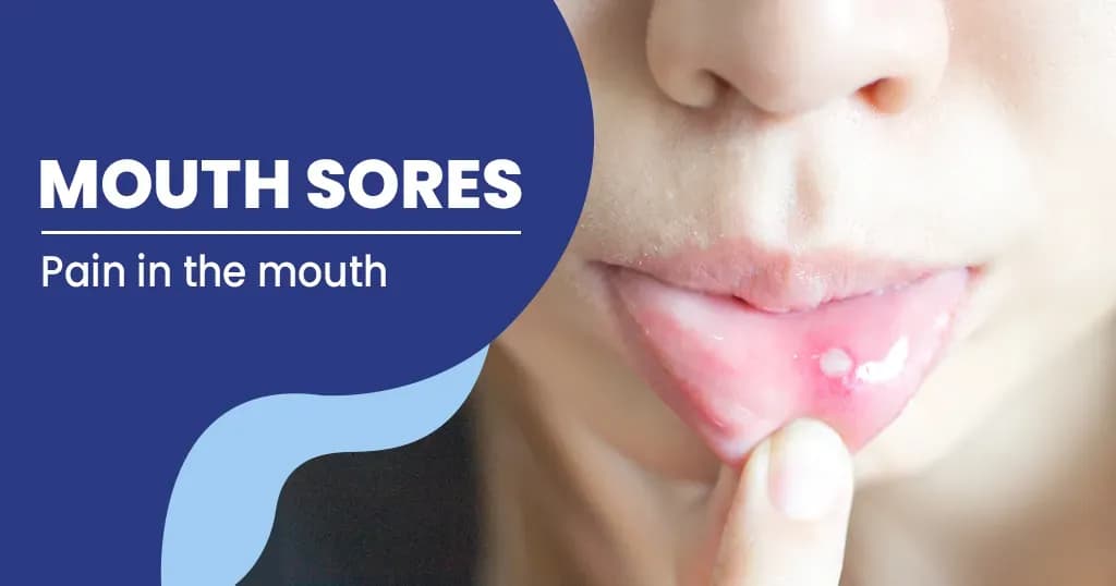 Mouth Sores Symptoms, Causes and Treatment 
