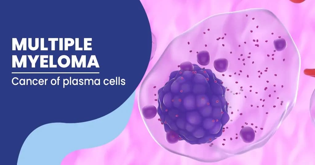 Multiple Myeloma Causes and Treatments
